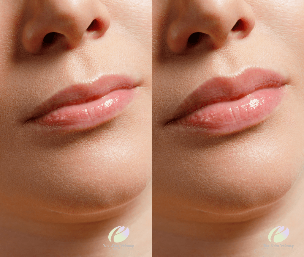 Tratamiento de relleno de labios, Erica Polonsky